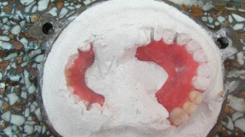 活动义齿蜡型制作视频,活动义齿蜡型制作过程详解